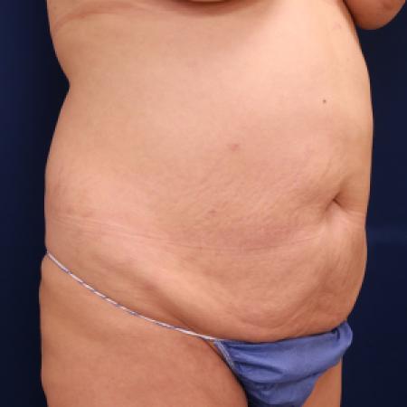 Before image 2 Case #111326 - Abdominoplasty and 360 lipo