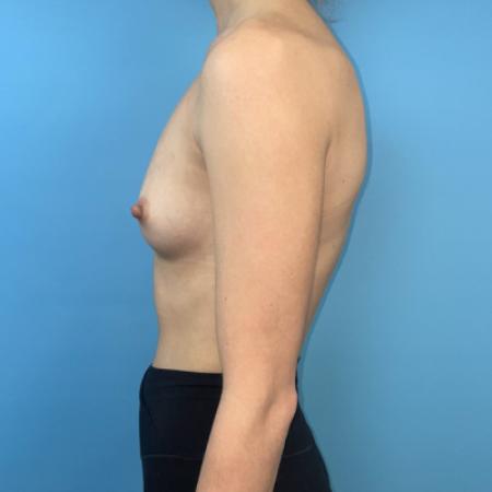 Before image 5 Case #111306 - Breast Augmentation