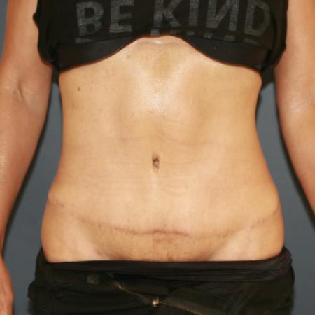 After image 1 Case #110796 - Fitness Tummy Tuck (Abdominoplasty)