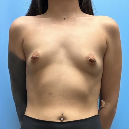 Before image 1 Case #110346 - Breast Augmentation