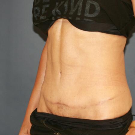 After image 2 Case #110796 - Fitness Tummy Tuck (Abdominoplasty)