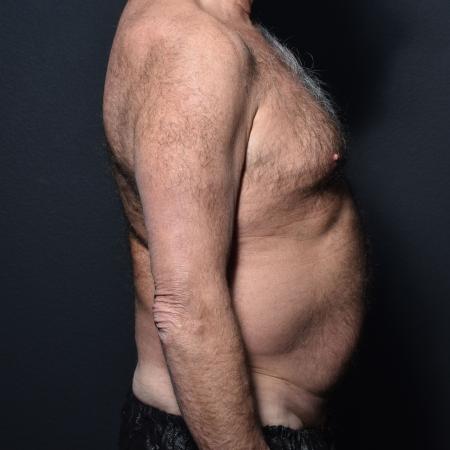 Before image 3 Case #111316 - Tummy Tuck and Liposuction