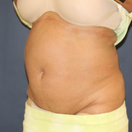 Before image 2 Case #110796 - Fitness Tummy Tuck (Abdominoplasty)