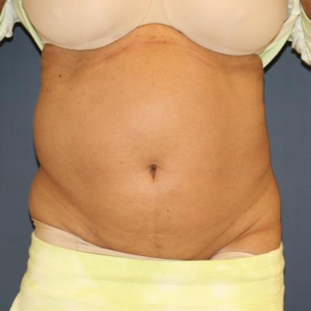 Before image 1 Case #110796 - Fitness Tummy Tuck (Abdominoplasty)