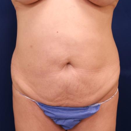 Before image 1 Case #111326 - Abdominoplasty and 360 lipo