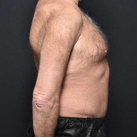 After image 3 Case #111316 - Tummy Tuck and Liposuction