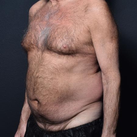 Before image 2 Case #111316 - Tummy Tuck and Liposuction