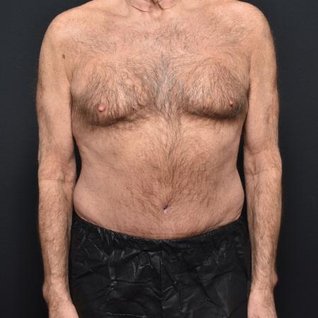 After image 1 Case #111316 - Tummy Tuck and Liposuction