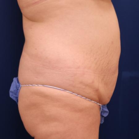 Before image 3 Case #111326 - Abdominoplasty and 360 lipo