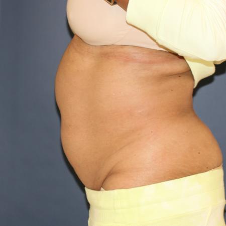 Before image 3 Case #110796 - Fitness Tummy Tuck (Abdominoplasty)