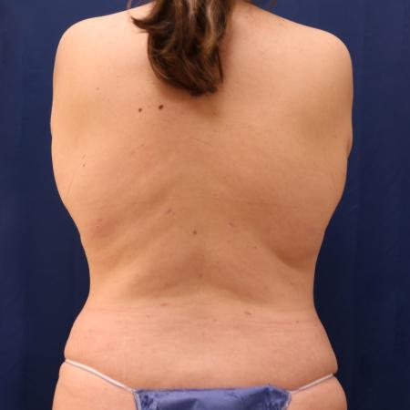 After image 4 Case #111326 - Abdominoplasty and 360 lipo