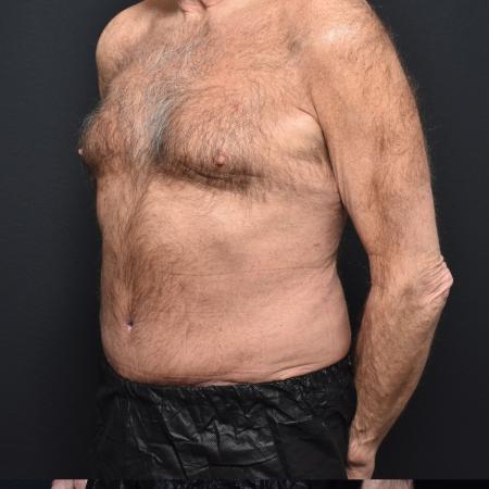 After image 2 Case #111316 - Tummy Tuck and Liposuction