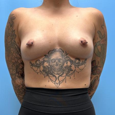 Before image 1 Case #111331 - Breast Augmentation 2