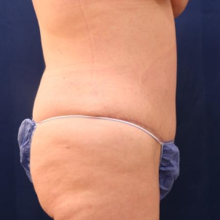 After image 3 Case #111326 - Abdominoplasty and 360 lipo