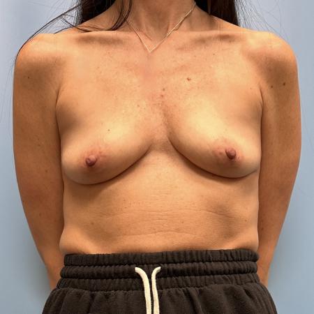 Before image 1 Case #111441 - Breast Augmentation 4