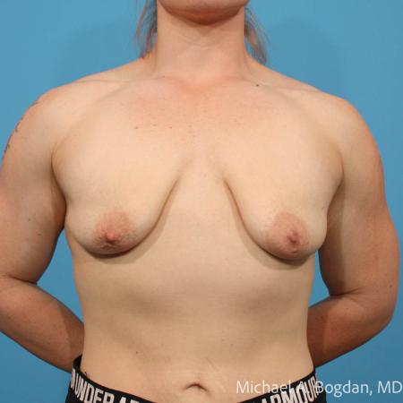 Before image 1 Case #111511 - Breast Augmentation