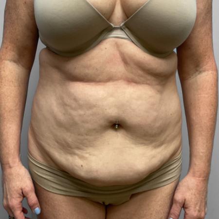 Before Case #111386 - Abdominoplasty with Liposuction