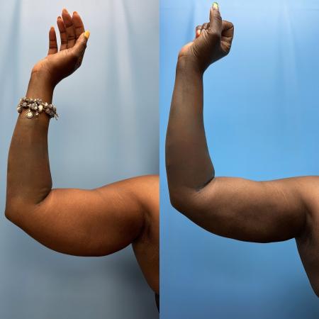 Before image 1 Case #111361 - Arm Liposuction with Renuvion Skin Tightening