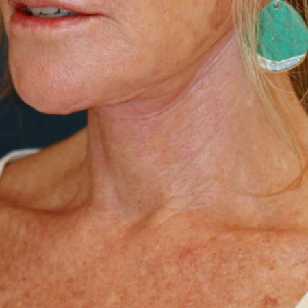 After image 2 Case #111531 - Female Necklift