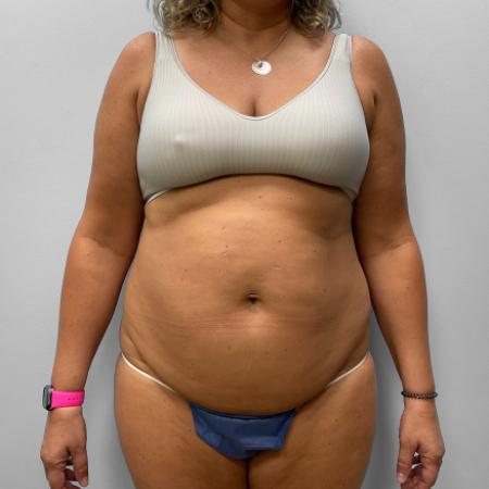 Before Case #111431 - Tummy Tuck & Liposuction