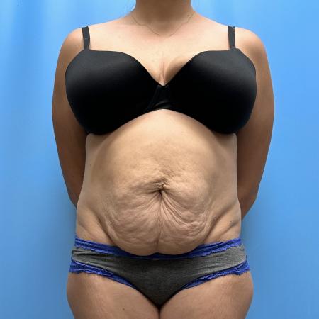 Before image 1 Case #111601 - Tummy Tuck with Lipo 360 3