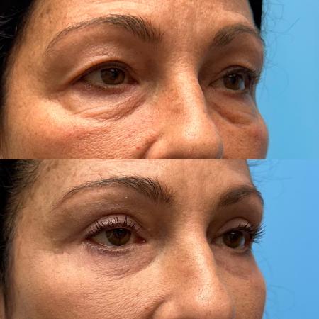 After image 2 Case #111446 - Blepharoplasty 2