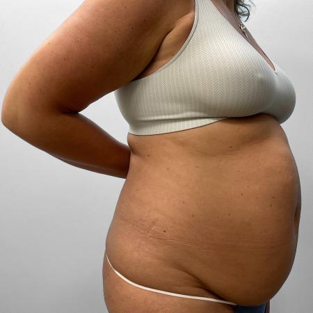 Before Case #111431 - Tummy Tuck & Liposuction