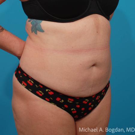 Before image 2 Case #111756 - Abdominoplasty