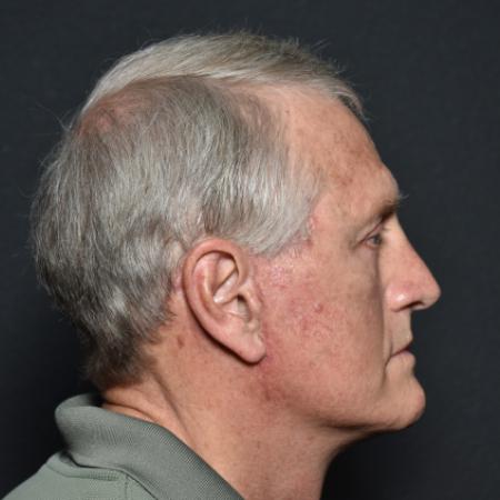 After image 3 Case #111826 - Face and Neck Lift