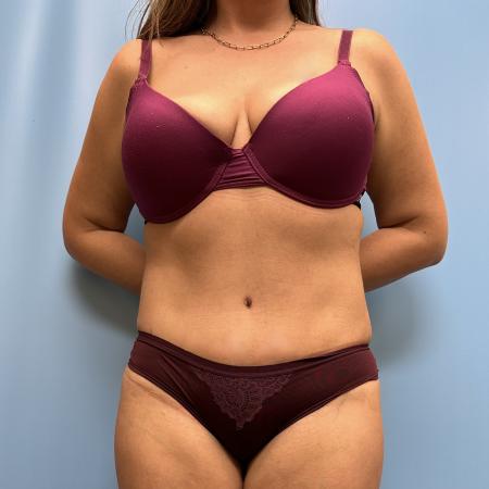 After image 1 Case #111466 - Tummy Tuck with Lipo 360 2