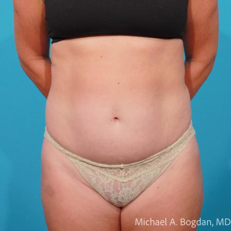 Before image 1 Case #111766 - Abdominoplasty