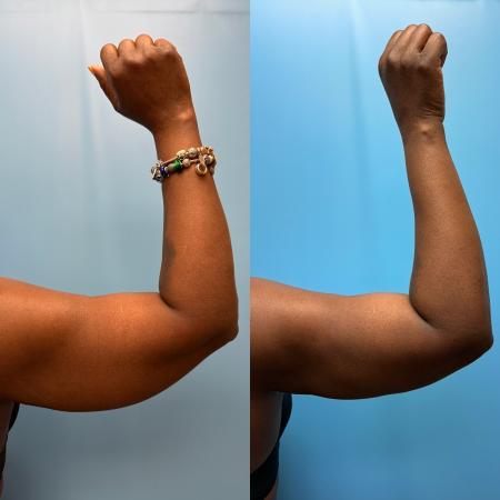After image 2 Case #111361 - Arm Liposuction with Renuvion Skin Tightening