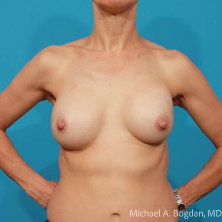 Before image 1 Case #111901 - Breast Implant Exchange