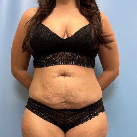 Before image 1 Case #111461 - Tummy Tuck with Lipo 360