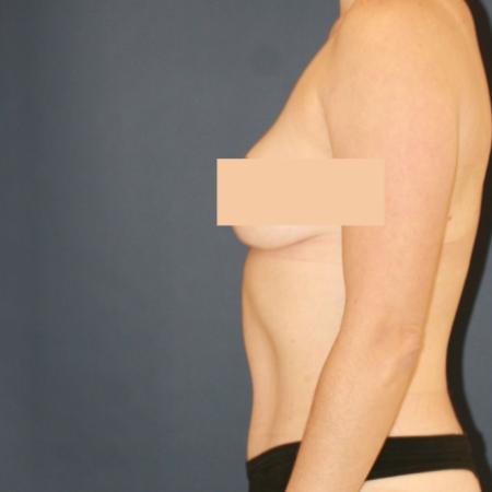After image 3 Case #111366 - Tummy Tuck (Abdominoplasty)