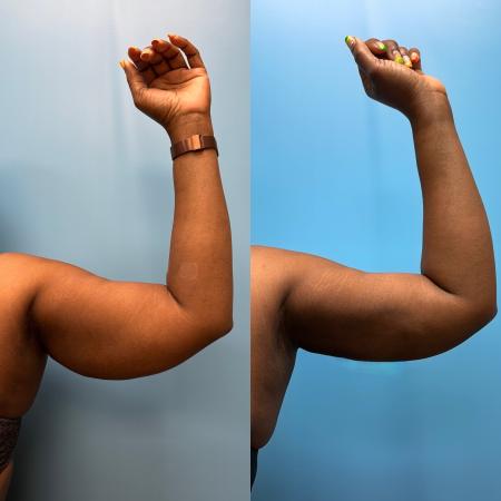 After image 1 Case #111361 - Arm Liposuction with Renuvion Skin Tightening