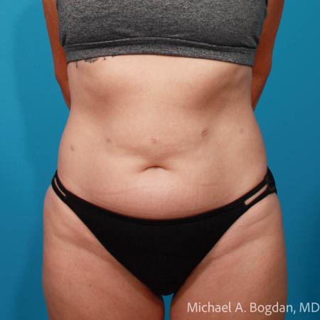 Before image 1 Case #111916 - Abdominoplasty