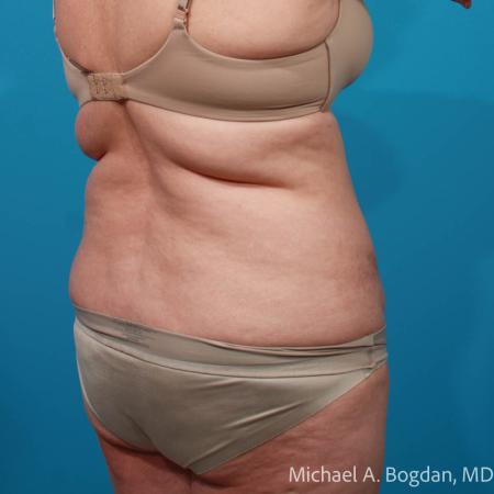 Before image 4 Case #111796 - Abdominoplasty