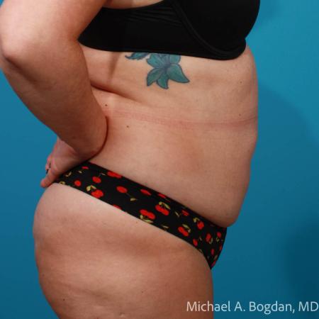 Before image 3 Case #111756 - Abdominoplasty