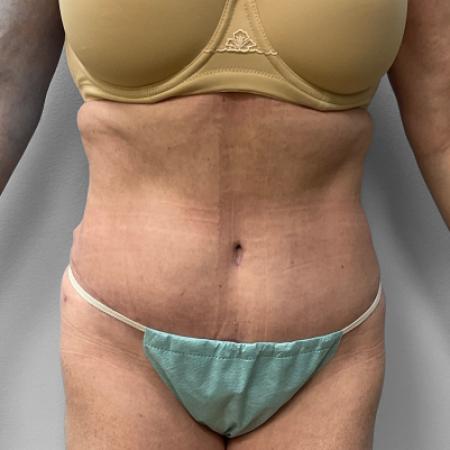 After Case #111386 - Abdominoplasty with Liposuction
