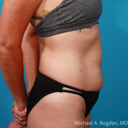 Before image 3 Case #111916 - Abdominoplasty