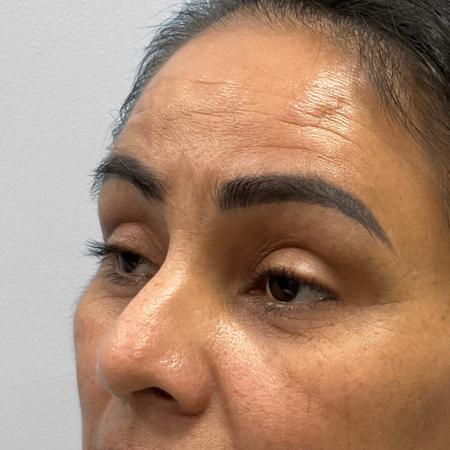 Before Case #111856 - Upper and Lower Blepharoplasty