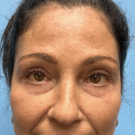 After image 1 Case #111446 - Blepharoplasty 2