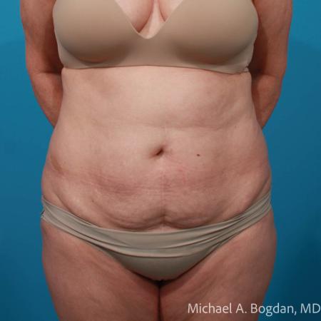 Before image 1 Case #111796 - Abdominoplasty