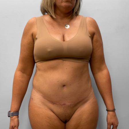 After Case #111431 - Tummy Tuck & Liposuction