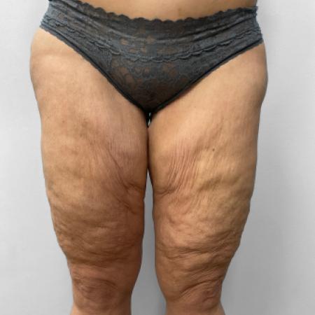 Before Case #111381 - Thigh Liposuction