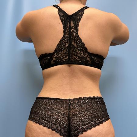 After image 4 Case #111461 - Tummy Tuck with Lipo 360