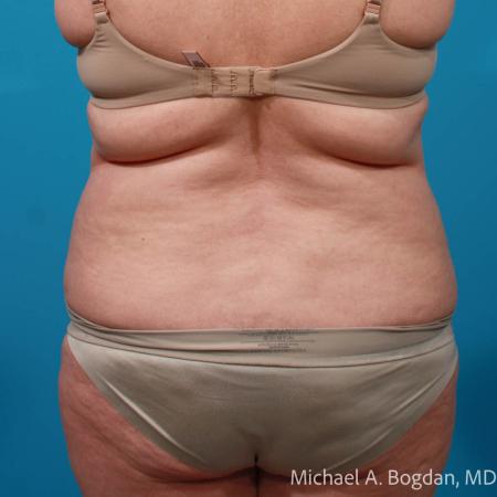 Before image 5 Case #111796 - Abdominoplasty