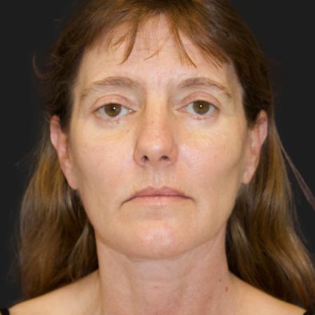 After image 1 Case #111876 - 47 Year-Old Patient | Custom Facial Rejuvenation