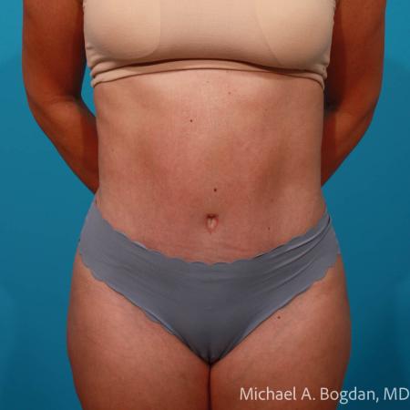 After image 1 Case #111766 - Abdominoplasty